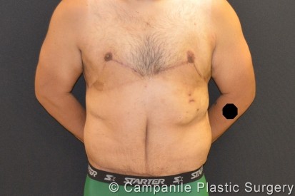 After Massive Weight Loss Patient Photo - Case 291 - after view
