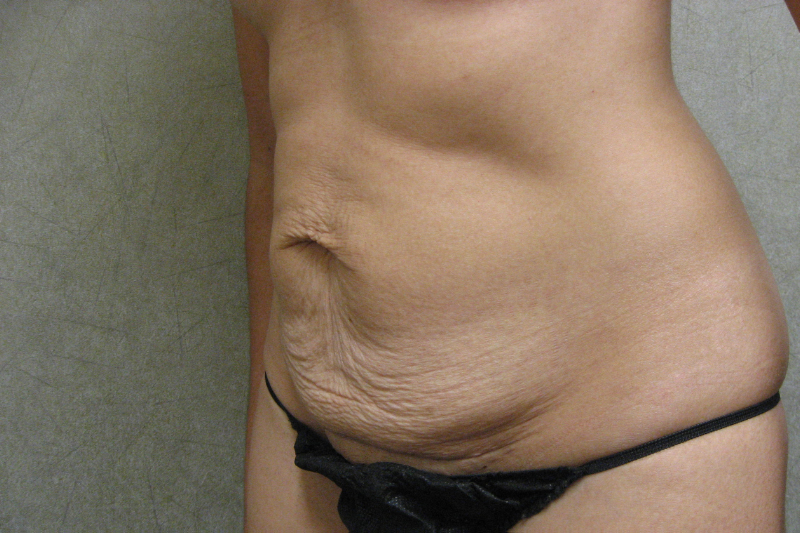 C.L.A.S.S.™ Tummy Tuck Patient Photo - Case 209 - before view-