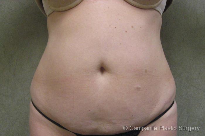 Tummy Tuck Patient Photo - Case 35 - before view-