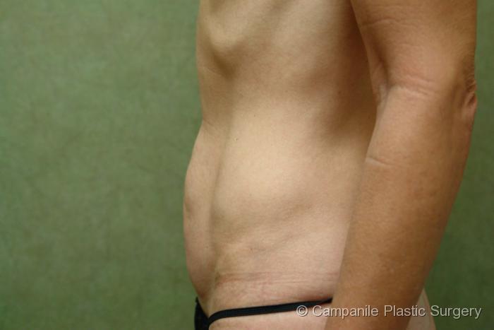 Tummy Tuck Patient Photo - Case 43 - before view-1