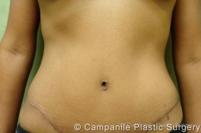 Tummy Tuck Patient Photo - Case 39 - after view