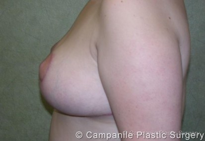 Breast Reduction Patient Photo - Case 163 - after view