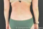 Liposuction - Case 299 - After
