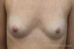 Breast Augmentation - Case 153 - Before