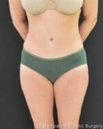 C.L.A.S.S.™ Tummy Tuck - Case 298 - After
