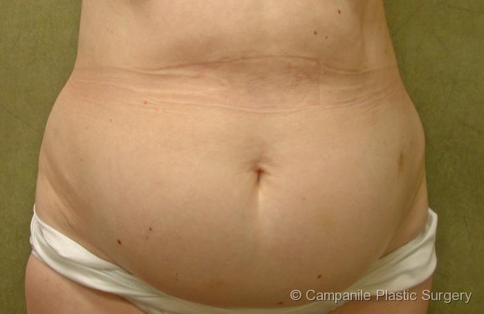 Tummy Tuck Patient Photo - Case 45 - before view-