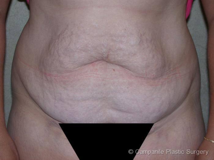 C.L.A.S.S.™ Tummy Tuck Patient Photo - Case 16 - before view-