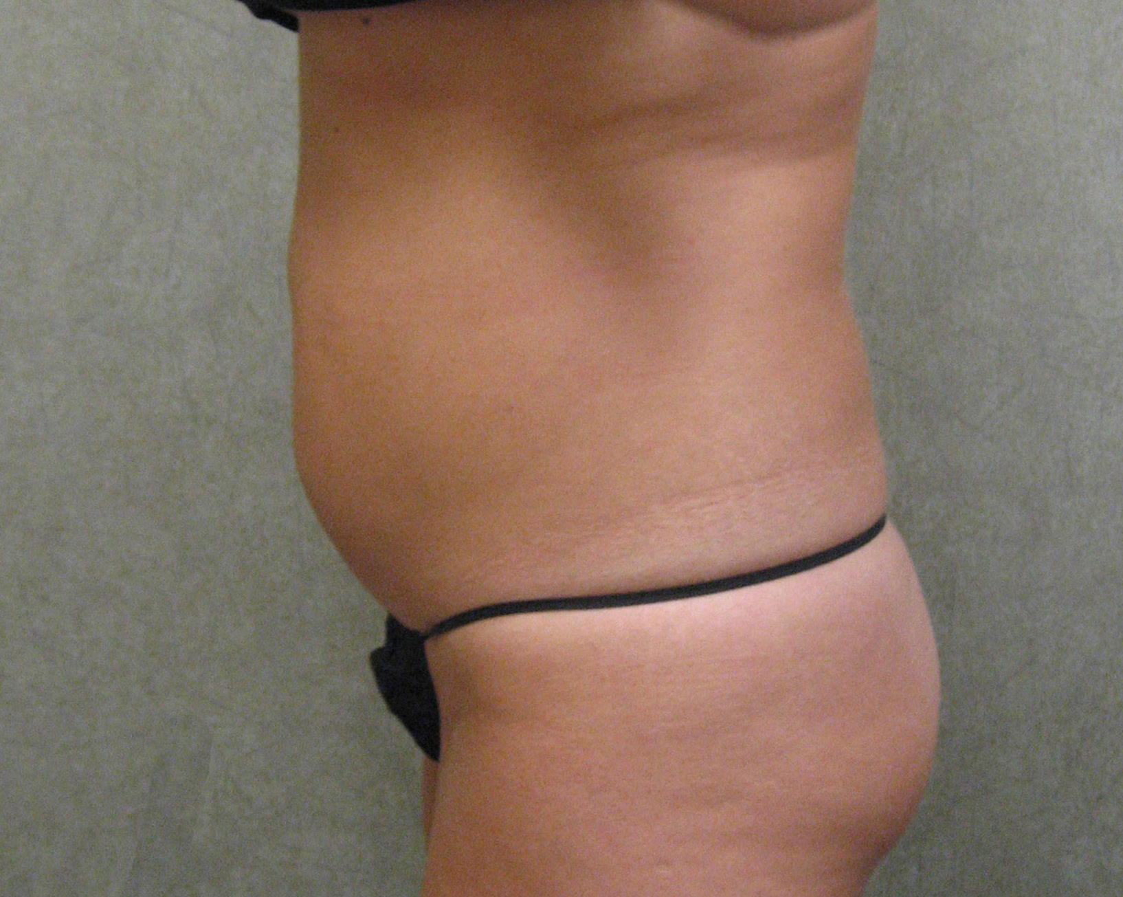 Liposuction Patient Photo - Case 213 - before view-