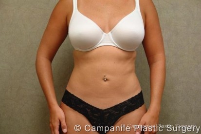 Liposuction Patient Photo - Case 56 - after view