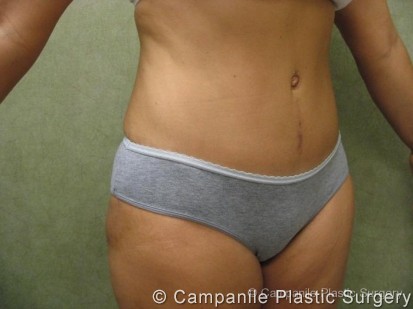 Tummy Tuck Revision Patient Photo - Case 52 - after view-1