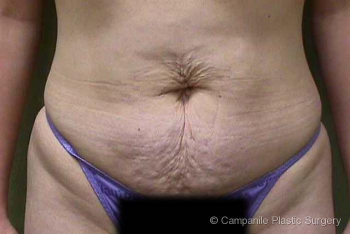 Tummy Tuck Patient Photo - Case 37 - before view-