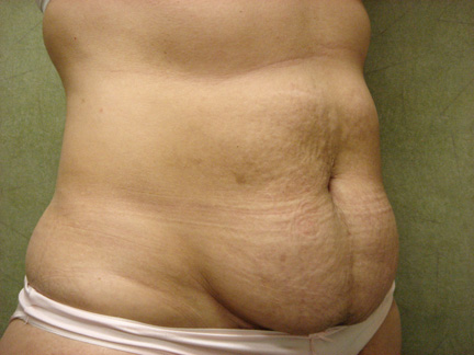 C.L.A.S.S.™ Tummy Tuck Patient Photo - Case 220 - before view-