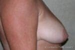 Breast Lift with Augmentation - Case 101 - Before