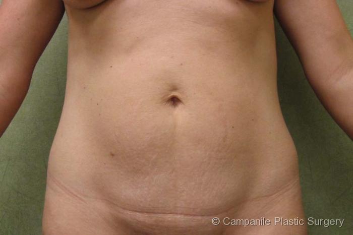 Mini Tummy Tuck Patient Photo - Case 46 - before view-