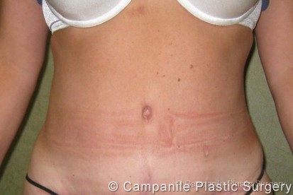 Tummy Tuck Patient Photo - Case 35 - after view