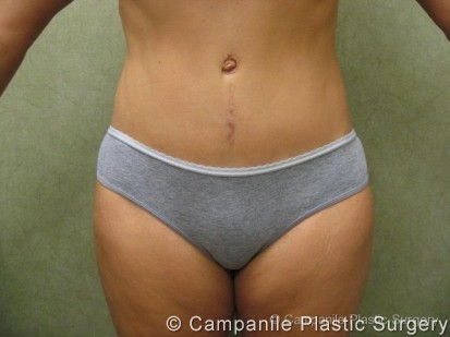 Case 52 - Tummy Tuck Revision Before and After Photo Gallery