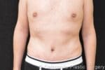C.L.A.S.S.™ Tummy Tuck - Case 289 - After