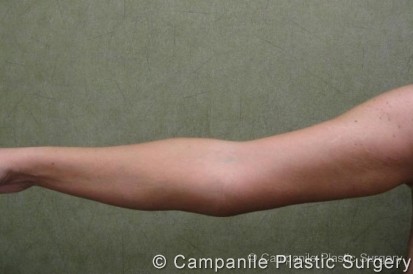 Arm Lift Patient Photo - Case 81 - after view