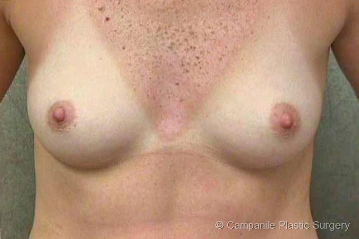 Breast Augmentation Patient Photo - Case 127 - before view-