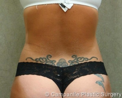 Liposuction Patient Photo - Case 64 - after view