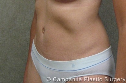 C.L.A.S.S.™ Tummy Tuck Patient Photo - Case 209 - after view