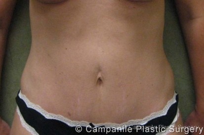 Mini Tummy Tuck Patient Photo - Case 46 - after view
