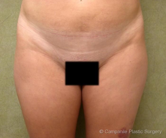 Liposuction Patient Photo - Case 63 - before view-