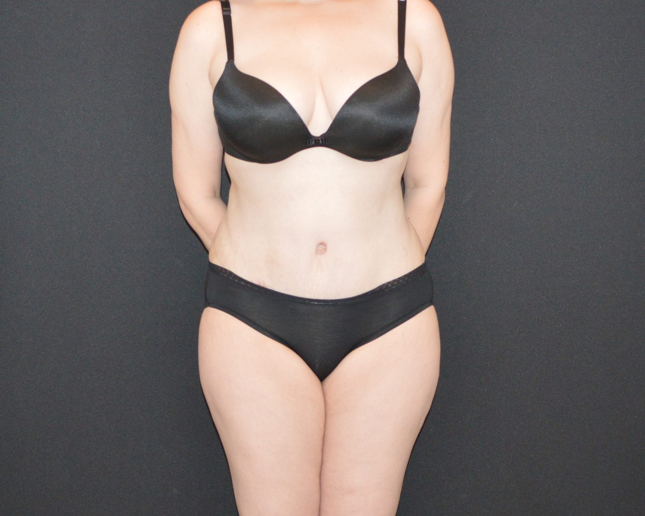 C.L.A.S.S. Tummy Tuck™ - Case 9515 - After