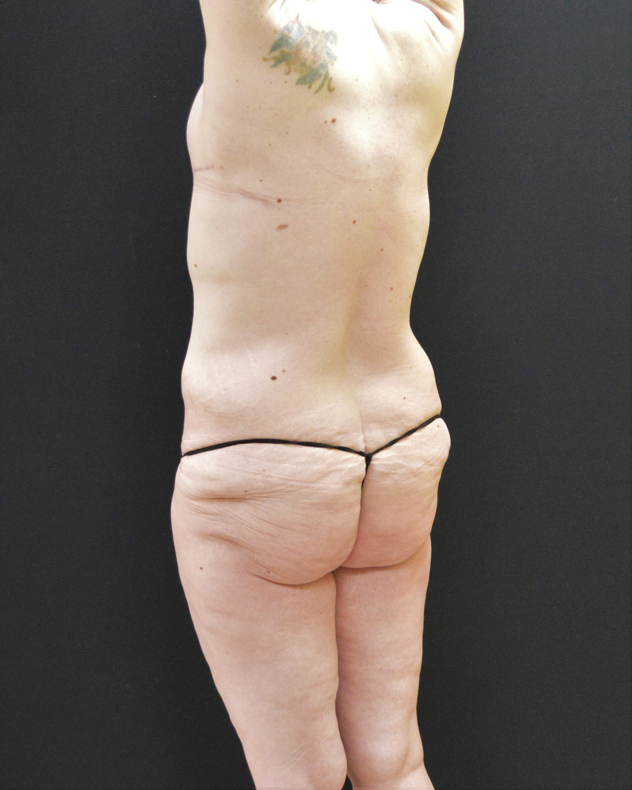 After Massive Weight Loss Patient Photo - Case 10089 - before view-