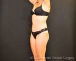 C.L.A.S.S.® Tummy Tuck - Case 7781 - After