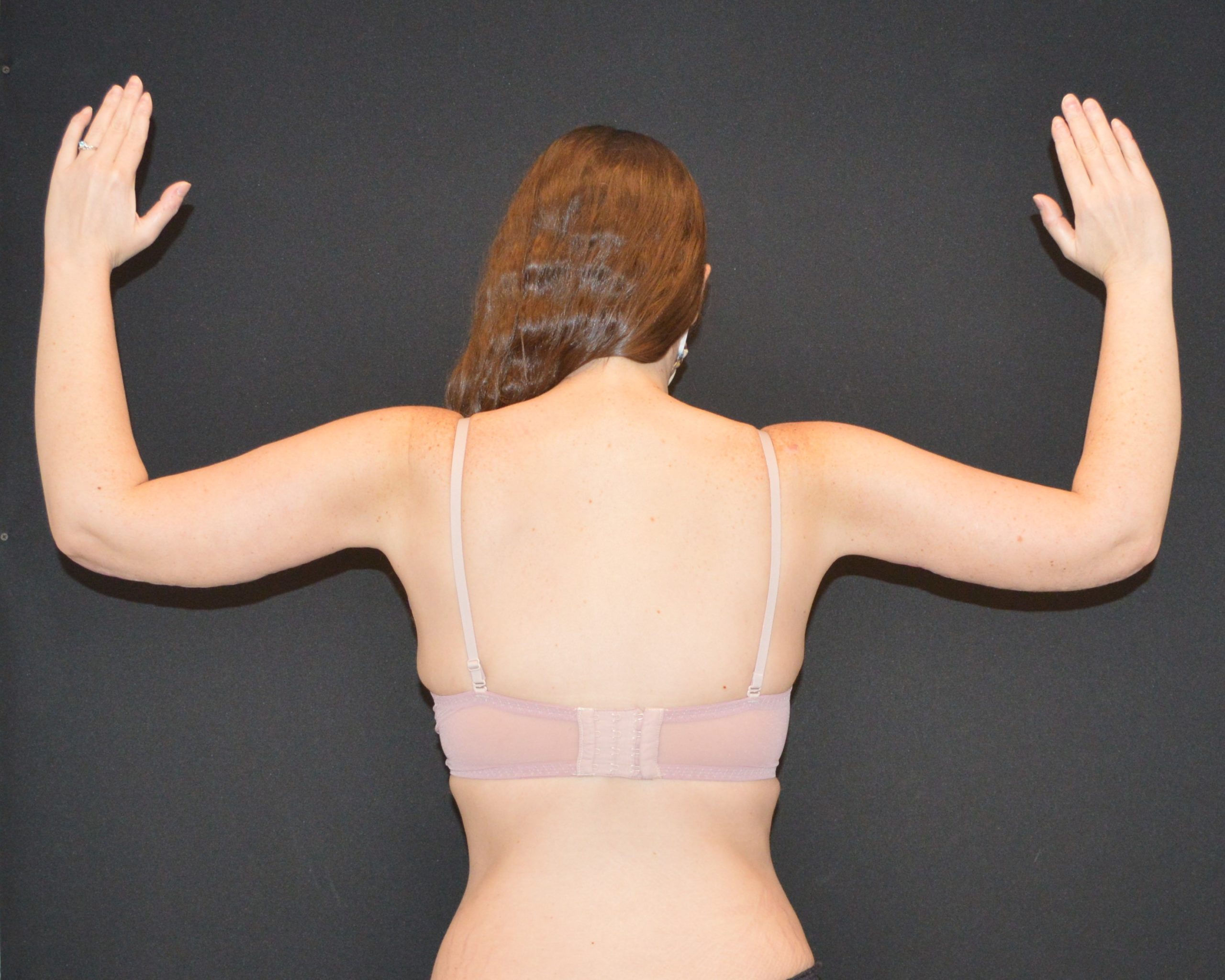 After Massive Weight Loss Patient Photo - Case 11212 - after view