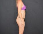 C.L.A.S.S.™ Tummy Tuck - Case 11228 - After