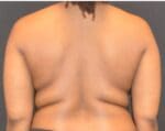 Liposuction - Case 11599 - Before