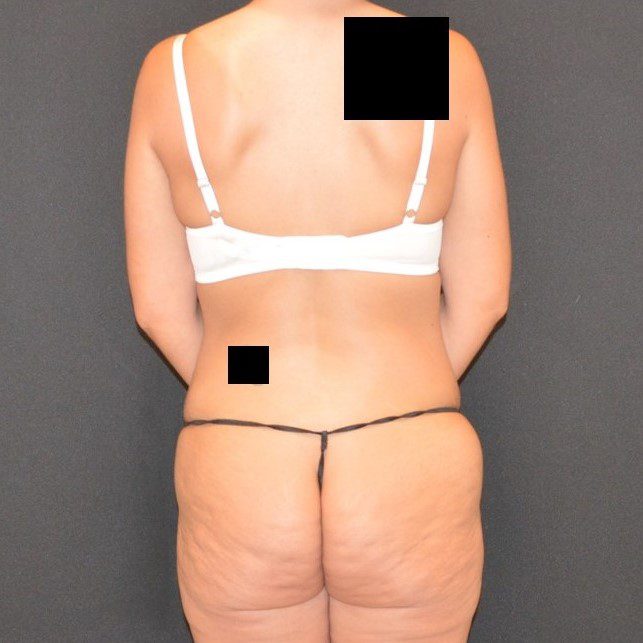 Lower Body Lift Patient Photo - Case 11633 - before view-