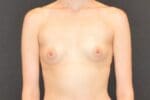 Fat Transfer to the Breasts - Case 11684 - Before