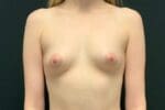 Fat Transfer to the Breasts - Case 11684 - After