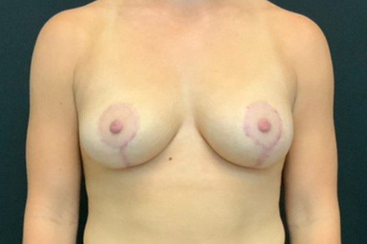 Breast Reduction Patient Photo - Case 11692 - after view