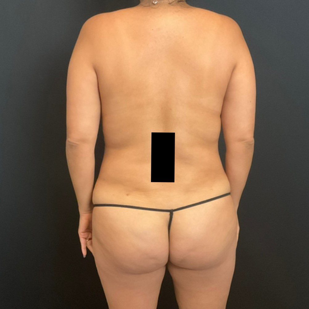Fat Transfer to the Buttocks Patient Photo - Case 11730 - before view-0