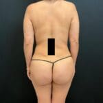 Fat Transfer to the Buttocks - Case 11730 - After