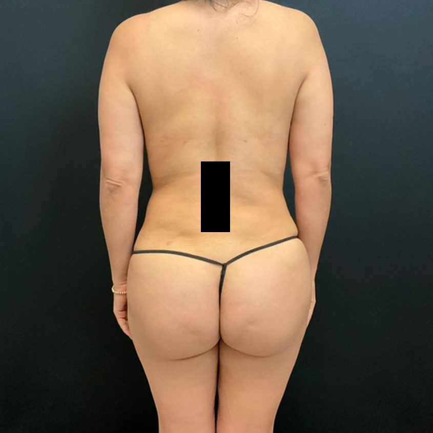 Fat Transfer to the Buttocks Patient Photo - Case 11730 - after view