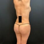 Fat Transfer to the Buttocks - Case 11738 - After