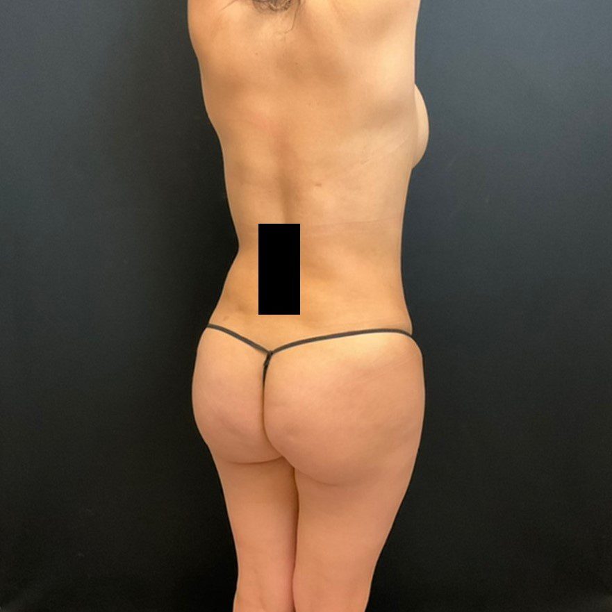Fat Transfer to the Buttocks Patient Photo - Case 11738 - after view-0