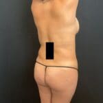 Fat Transfer to the Buttocks - Case 11738 - Before