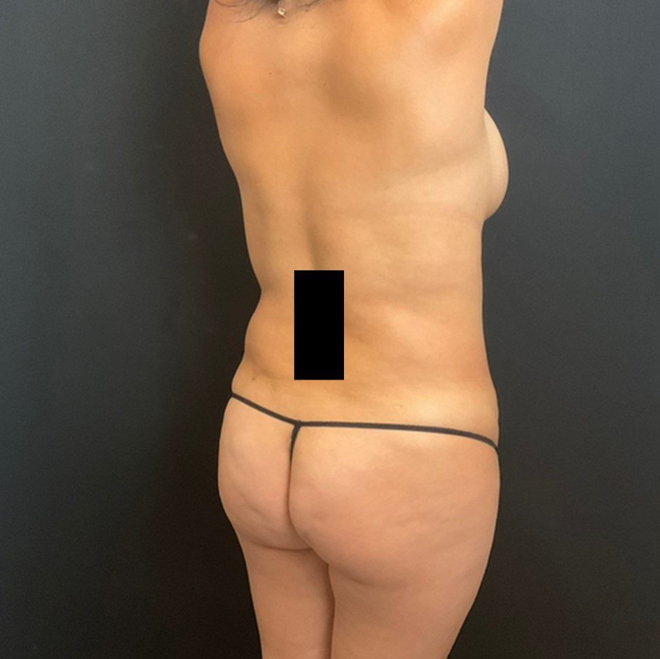Fat Transfer to the Buttocks Patient Photo - Case 11738 - before view-0