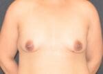 Fat Transfer to the Breasts - Case 11751 - Before