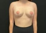Breast Surgery Revision - Case 11784 - After