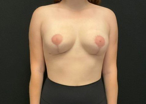 Breast Surgery Revision Patient Photo - Case 11784 - after view