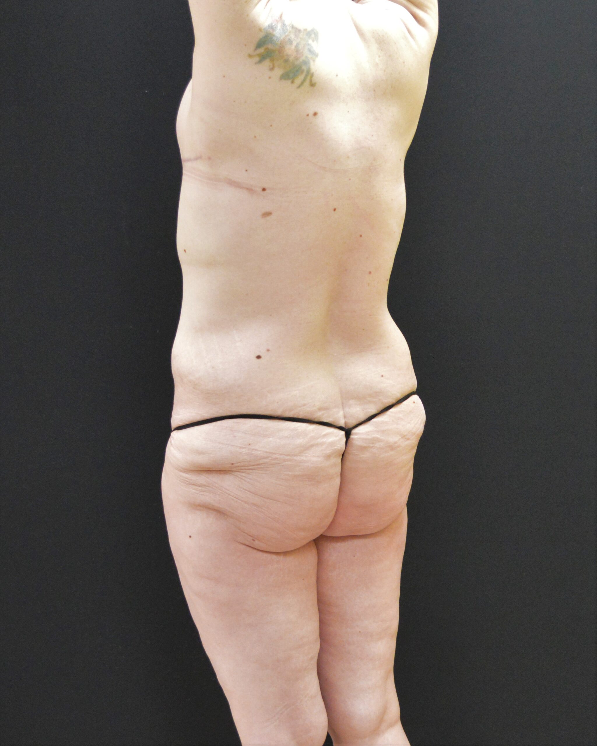 After Massive Weight Loss Patient Photo - Case 12124 - before view-