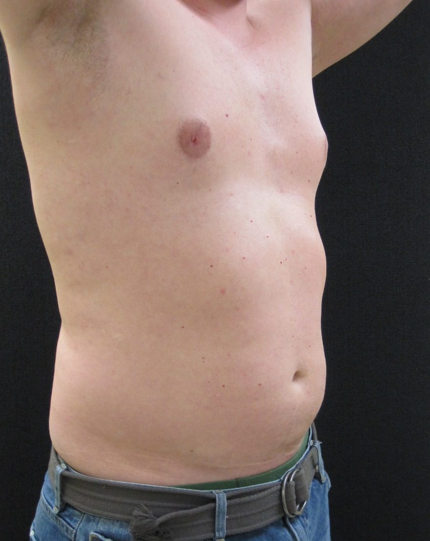 Liposuction Patient Photo - Case 12147 - before view-1