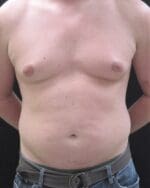 Liposuction - Case 12147 - Before